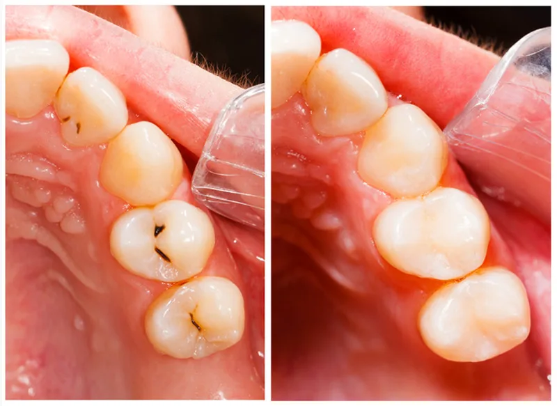 Fillings