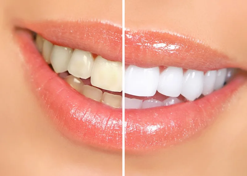 Teeth Whitening at Flossed Family Dentistry in San Tan Valley, AZ